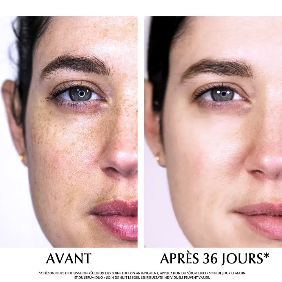 avant apres anne laure anti pigment